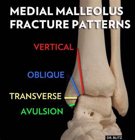 5 Kinds of Fractures From a Twisted Ankle | Broken ankle, Ankle fracture, Broken ankle recovery