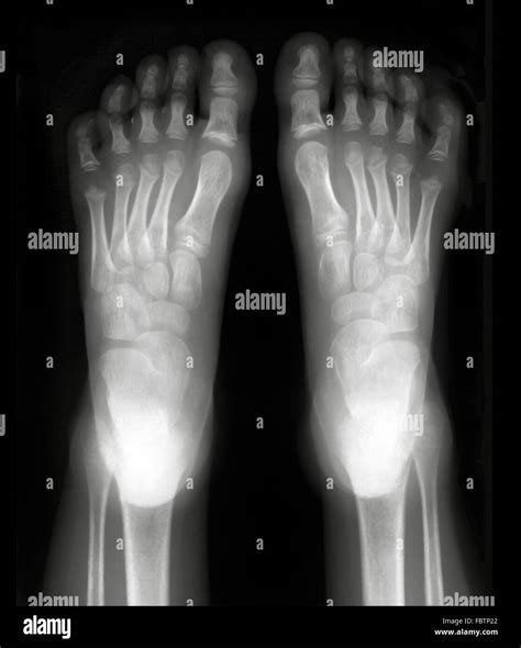 Xray Normal Foot