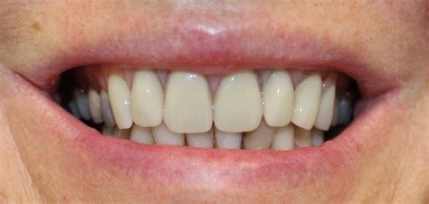 Partial Dentures (plates) - Northland Prosthodontics - Northland Denture Specialist - Whangarei