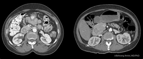 Roentgen Ray Reader: Annular Pancreas