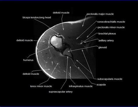 shoulder anatomy | mri shoulder axial anatomy | free cross sectional anatomy | | Shoulder ...