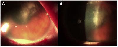 Frontiers | Case Report: Molecular Diagnosis of Fungal Keratitis Associated With Contact Lenses ...