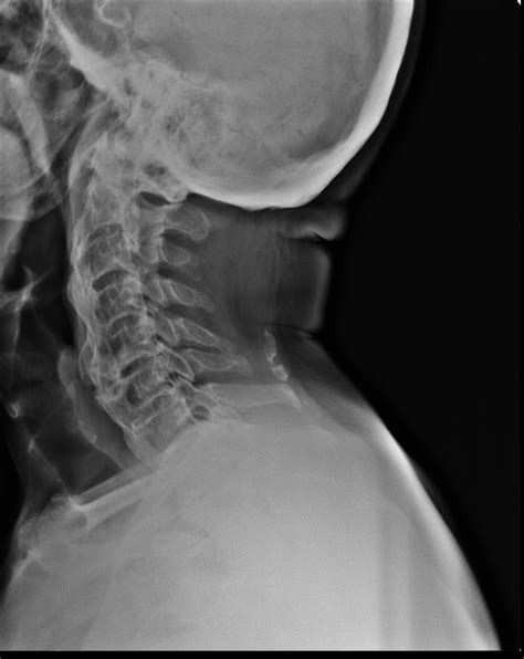 Diffuse Idiopathic Skeletal Hyperostosis (DISH) Causes, Symptoms, Diagnosis and Treatment ...