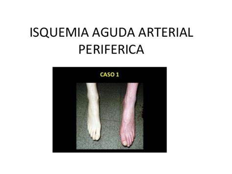 Isquemia aguda arterial periferica