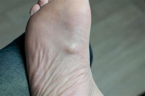 Plantar Fibroma What You Need to Know