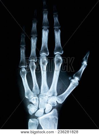 X-ray Human Hand. X- Image & Photo (Free Trial) | Bigstock