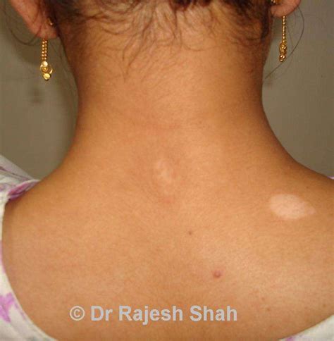 Vitiligo: Chances of Recovery explained by Dr. Shah