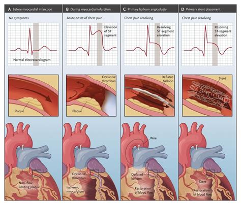 Study Flowchart Stemi St Elevation Myocardial Infarct - vrogue.co