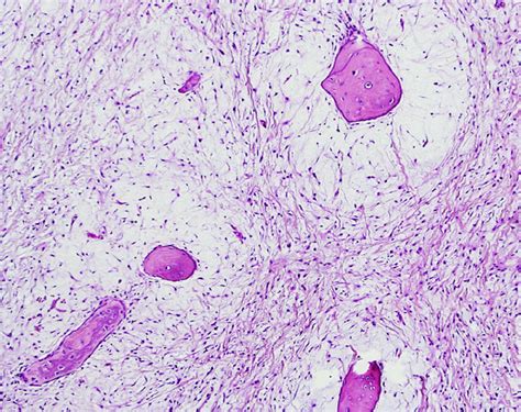 Odontogenic myxoma with diffuse calcifications: a case report and review of a rare histologic ...