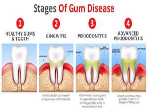 How To Relieve Gum Pain – 123 Dental Emergency