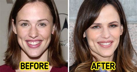 17 Celebrities Who Decided to Change Their Teeth and Started Shining ...