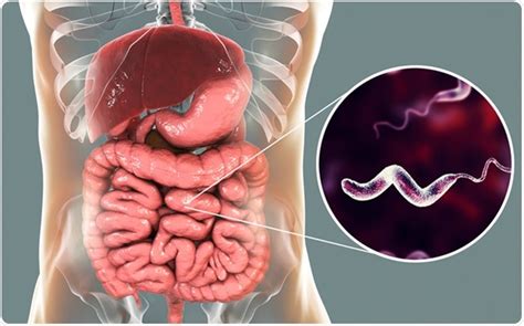 Campylobacteriosis Symptoms