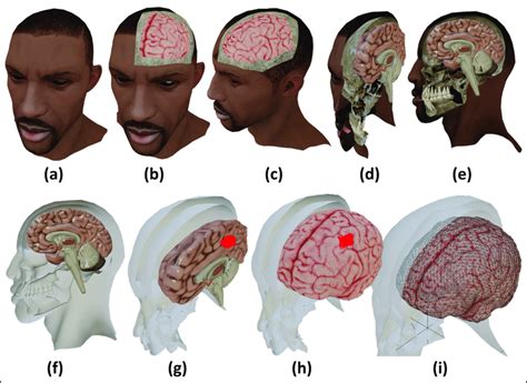 (a) 3D model of a human head; (b) cut in the skull and scalp in the ...