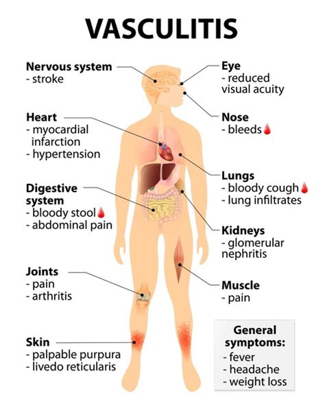 Vasculitis and kidneys| Mesogeios