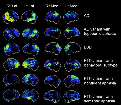 FDG-PET scan patterns displayed in NeuroStat 3D-SSP for focal onset ...