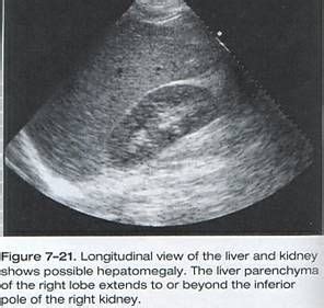 WK 2 LIVER HEPATOMEGALY http://crashingpatient.com/wp-content/images/part1/image015.jpg | Abd ...