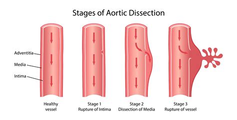 An Overview of Aortic Dissection