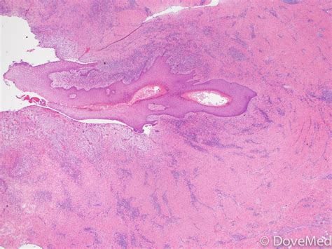 Pilonidal Cyst