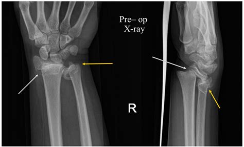 Cureus Combined Radial And Ulnar Epiphyseal Injury At The Wrist A | The Best Porn Website