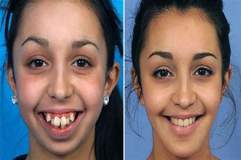 How Can Clear Aligners Change your Facial Structure | SD Align