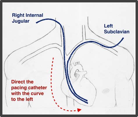 Dr. Smith's ECG Blog: Emergency Transvenous Cardiac Pacing