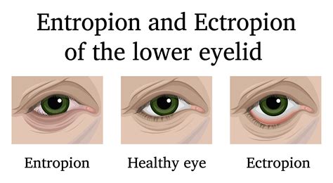 What Is Entropion Surgery