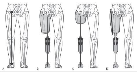 Figure 3 from Transfemoral Amputation : Prosthetic Management | Semantic Scholar