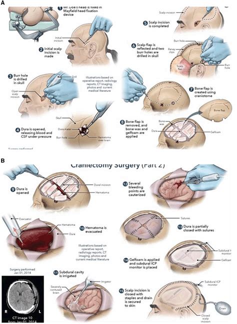 a Illustration of decompressive craniectomy procedure. b Illustration... | Download Scientific ...