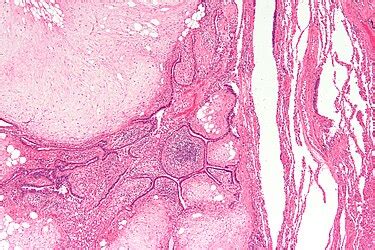 Hamartoma - Libre Pathology