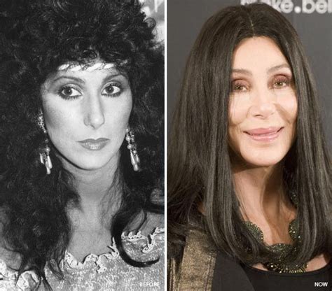 Cher Plastic Surgery Before & After | Cher plastic surgery, Celebrities ...