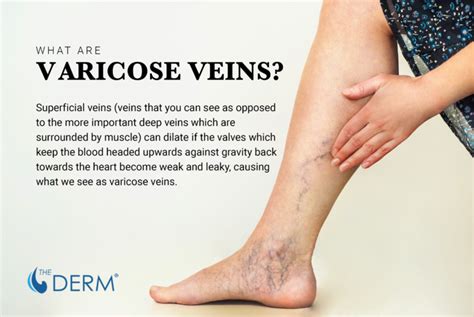 Varicose Veins: What’s the Deal and How to Heal - The Derm | Dermatologists in Cook County, IL