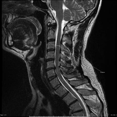 Cervical canal stenosis | Image | Radiopaedia.org