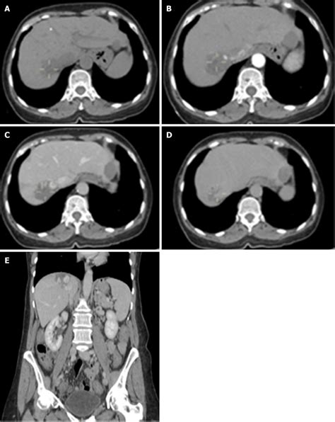 Hepatic hemangioma of 49 mm × 30 mm. A: Non-contrast phase; B: Arterial... | Download Scientific ...