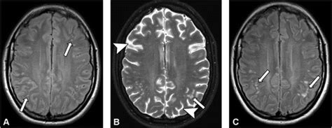 Anti–NMDA-Receptor Encephalitis | RadioGraphics