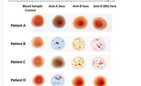 Solved Look at the following Blood Typing (agglutination | Chegg.com