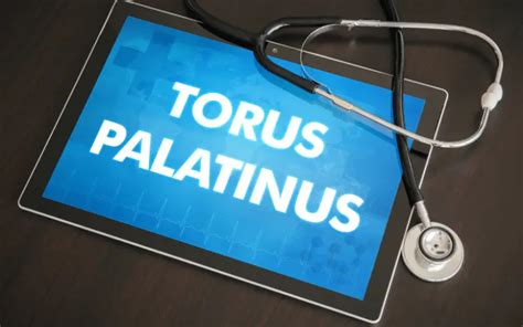 Top 10 Symptoms of Torus Palatinus: Demystifying the Dental Phenomenon