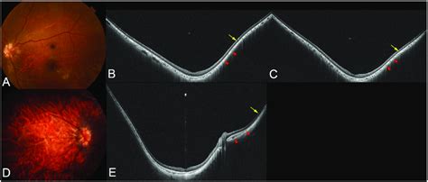 Images of highly myopic eyes with macular staphyloma. (A) Fundus... | Download Scientific Diagram