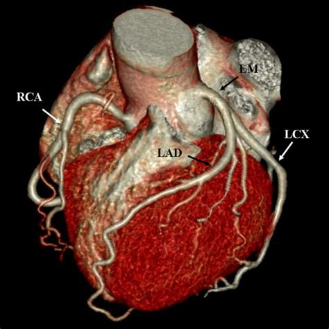 Volume rendering image shows the branches of coronary artery. LM: left... | Download Scientific ...