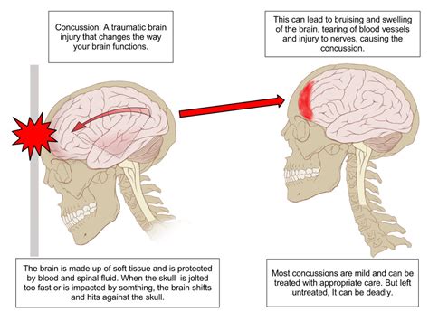 Traumatic Brain Injuries - Signs, Symptoms, and Causes | McGehee ...