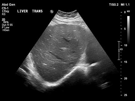 Cirrhosis Ultrasound