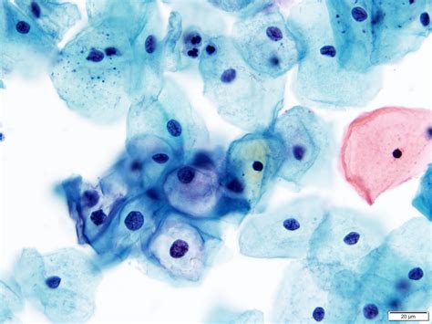 Pathology Outlines - LSIL (cytology)