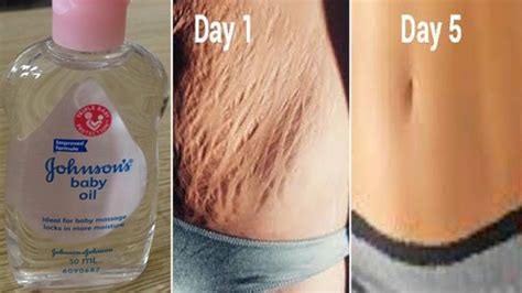 World's best Remedy for Fast Stretch mark Removal \\ In 5 Days Remove Stretch Marks Completely ...