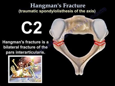 Hangman's Fracture, C2 Fracture - Everything You Need To Know - Dr. Nabil Ebraheim - YouTube