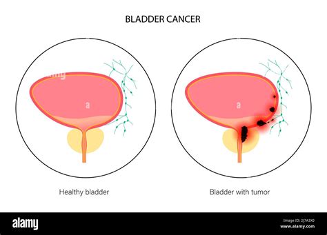 Bladder cancer stages, illustration Stock Photo - Alamy