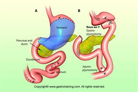 Gastroenterology Education and CPD for trainees and specialists » Roux ...