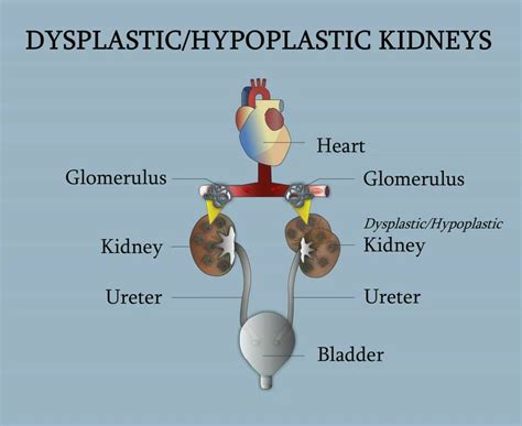 Dysplastic/Hypoplastic Kidneys - YouTube