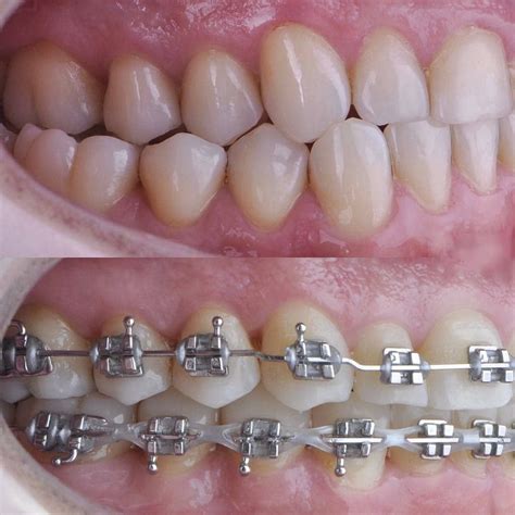 Correcting cross bite with orthodontic brackets (With images ...