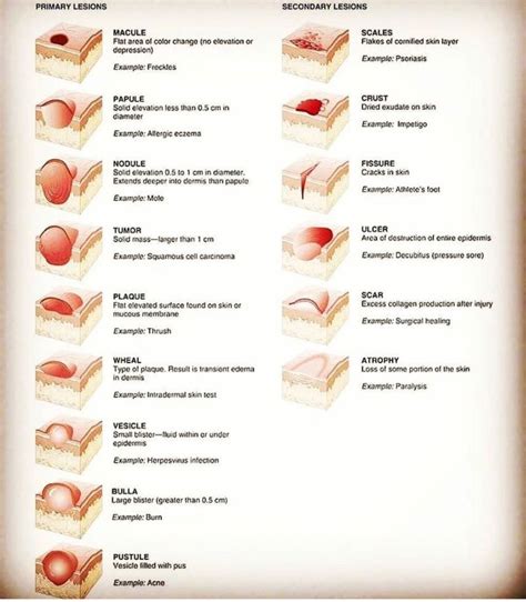 Vesicle Skin