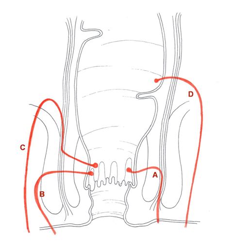 Anorectal Fistula Classification