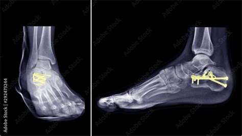 Film ankle X-ray radiograph showing heel bone broken (Calcaneus fracture) which treated by ...